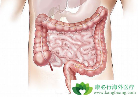 结肠癌的症状 结肠癌的症状