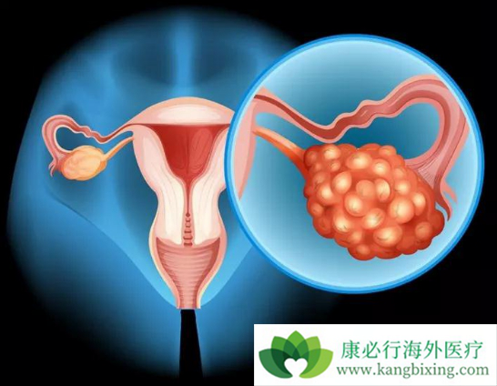 妇科肿瘤 妇科肿瘤