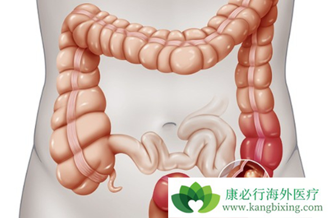 结直肠癌 结直肠癌