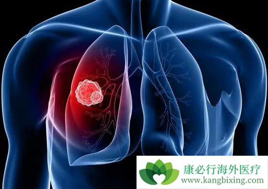 肺癌复发症状 肺癌复发症状