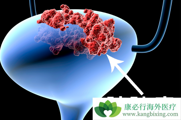 膀胱癌的早期症状 膀胱癌的早期症状