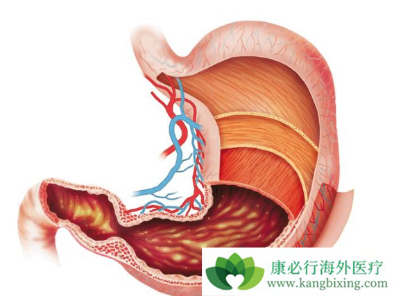 胃癌晚期能活多久 胃癌晚期能活多久