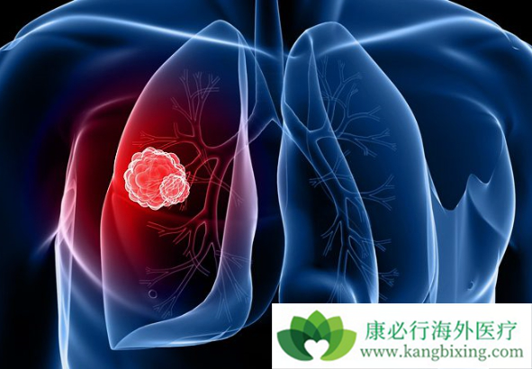 肺癌化疗 肺癌化疗