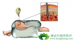 ������ֲ�ǲ������ư�Ѫ������Ч������