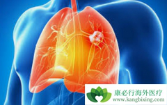 ��ķ����(Keytruda)�ڷΰ�����������ռ����Ҫ��λ