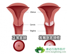 HPV����ֻ��Ԥ����������������Ҫ��HPV������