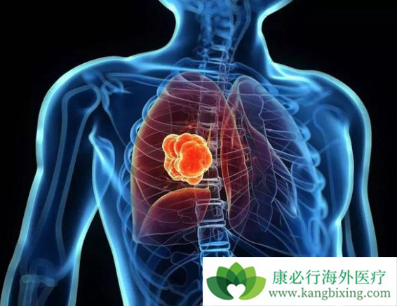 肺癌术后治疗 肺癌术后治疗