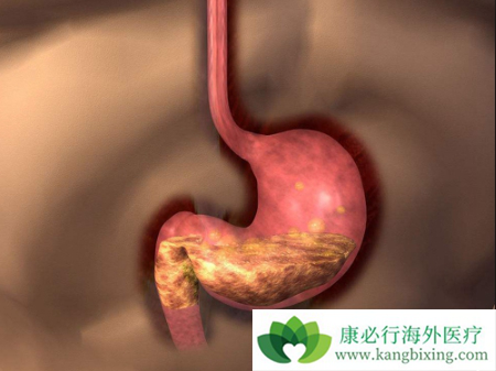 阿帕替尼 阿帕替尼