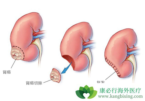 肾癌晚期 肾癌晚期