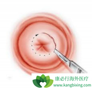 HPV��Ⱦ������Ҫ���շ���������ԭ��֮һ