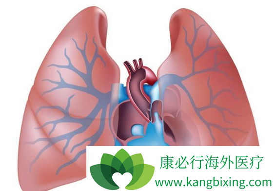 肺动脉高压症状 肺动脉高压症状