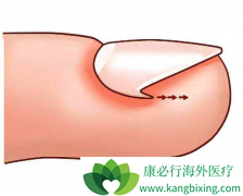 ʹ�ð���ҩ�����ּ׹�����ô�죿