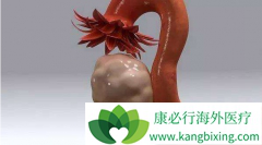 ����ҽ�Ƹ��ߴ����ЧԤ���������ķ������˽���HPV���绹��ʲô