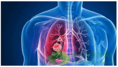 ������ALK����ҩ��������Ĳ�����Ӧ