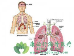 ת���Է�Сϸ���ΰ�BRAF����ͻ��������ҩ��ô�죿