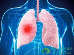 �ΰ�EGFR����ͻ�������ΰ�����ҩ��ѡ��