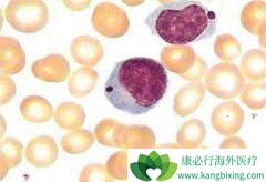 Bϸ���ܰ��������ʴﵽ80%�����Ʒ���CAR-T���ش�ͻ��