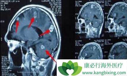 �����ķΰ���ת��֢״����Щ��