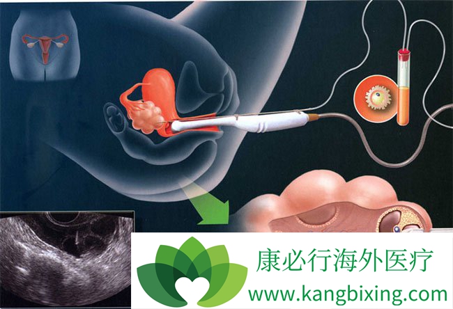 做试管婴儿最受罪的是哪个环节?