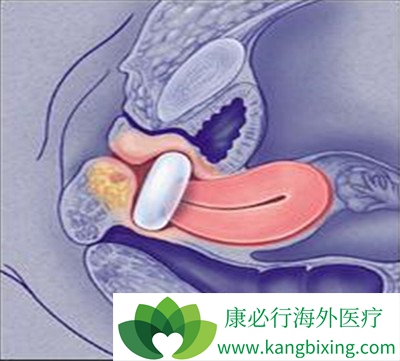 子宫内膜太薄做试管婴儿能成功吗