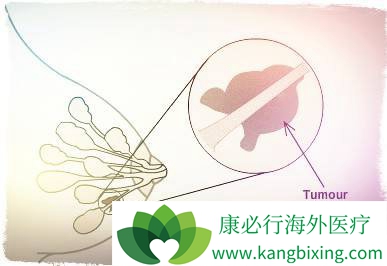 乳腺癌筛查