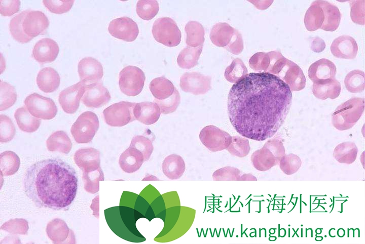 慢性淋巴细胞性白血病