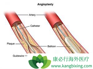 心脏支架