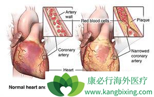 心脏支架