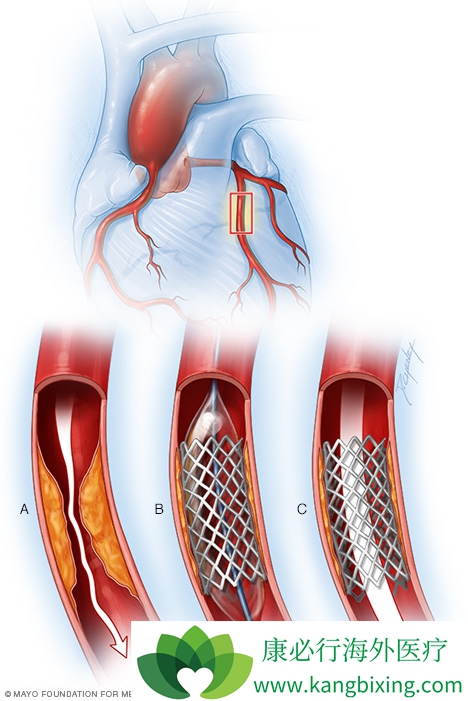 心脏主动脉支架图片