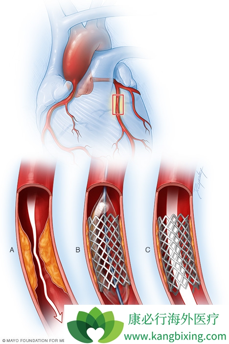 血管支架 示意图图片