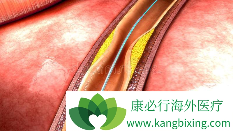 心脏支架
