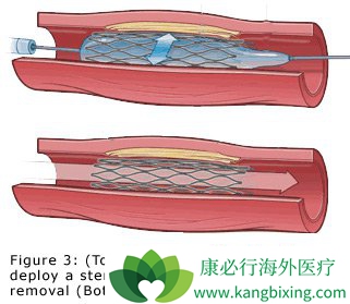 心脏支架