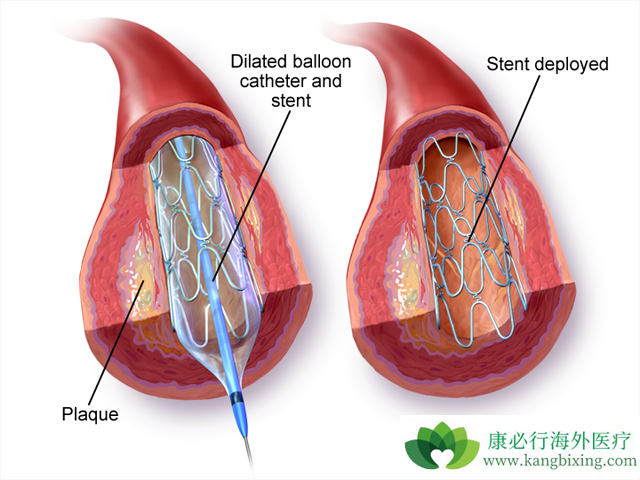 心脏支架