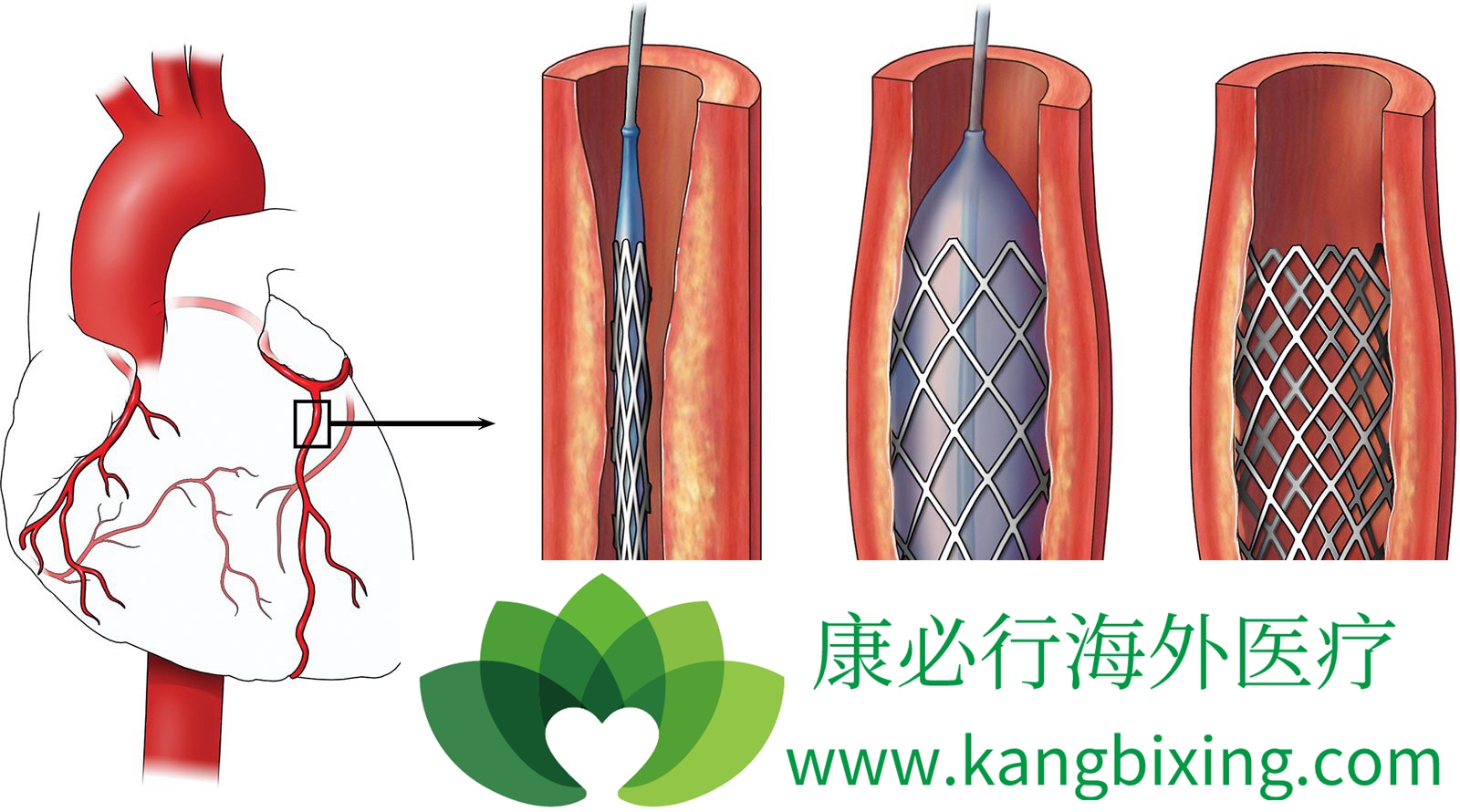 心脏支架手术过程图解图片