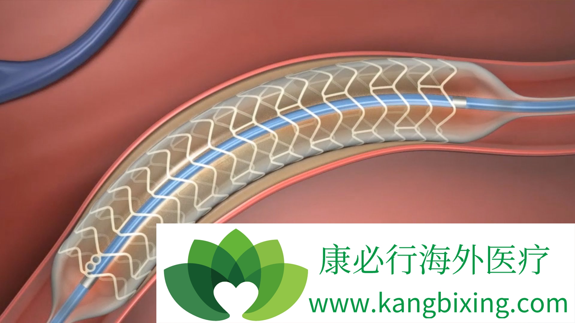 心脏支架