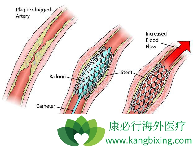 心脏支架