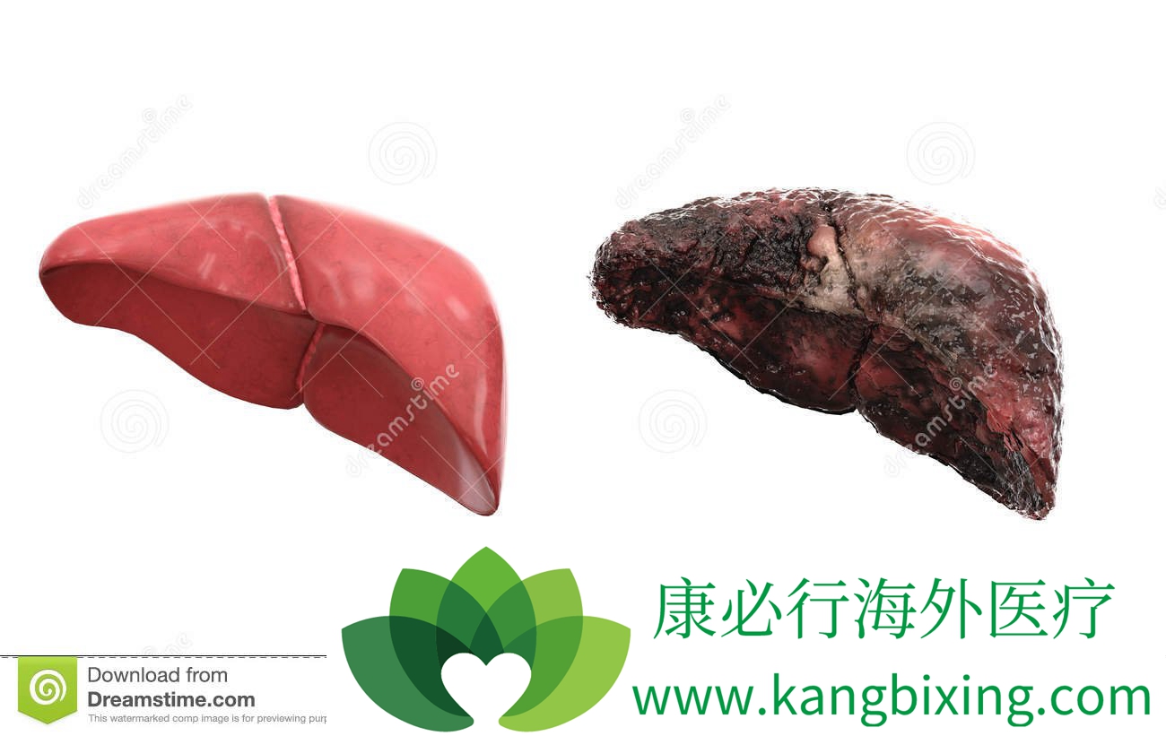 丙肝的治疗方法