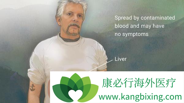 丙肝的治疗
