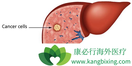 肝癌
