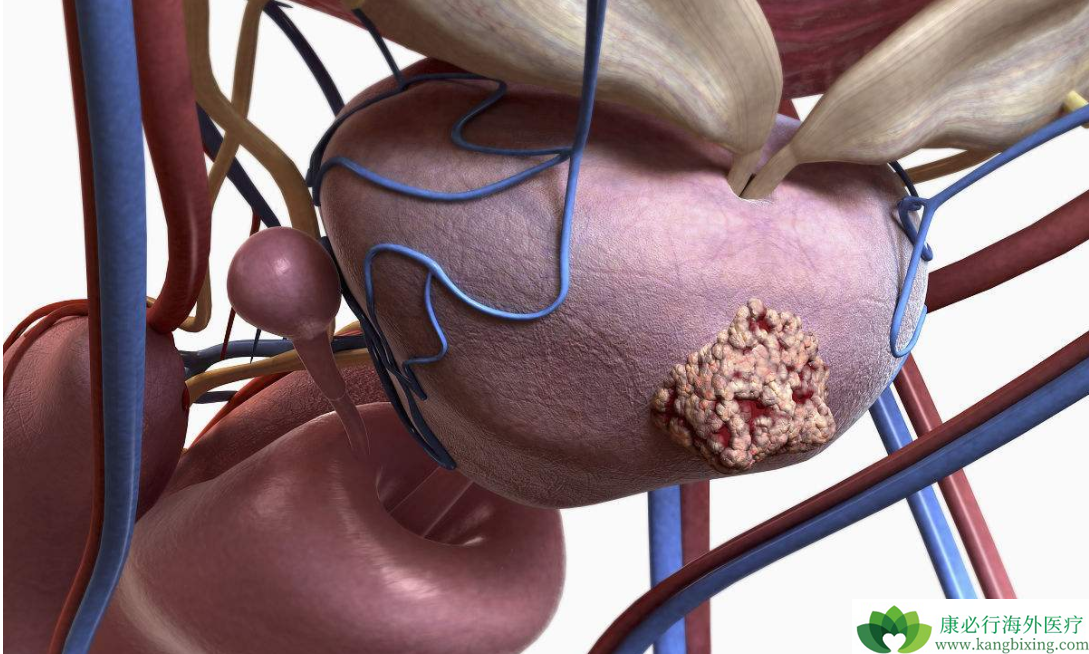 CRPC前列腺癌图片
