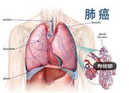 ��ʹ�Ƿΰ���ת�Ƶ����֢״