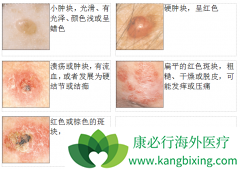 ��ͬ���͵�Ƥ����֢״��ͬ