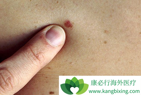 初期皮肤癌症状大多数是基底较硬斑块状丘疹