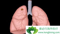 �׿��Ƿǳ����͵ķΰ�����֢״