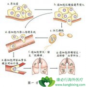 ��֢������β��ܱ�����ְ�֢ת�Ƹ���